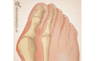 voet-hallux-valgus-anatomie voet-hallux-valgus-anatomie